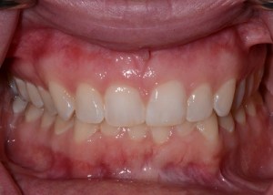 Orthodontics patient 1