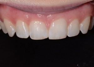 Orthodontics patient 1