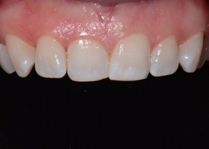 Orthodontics patient 1