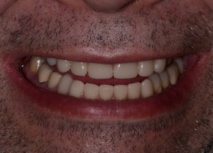Complete Smile Makeover patient 5
