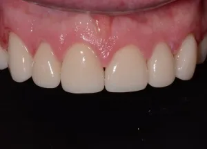 Complete Smile Makeover patient 5