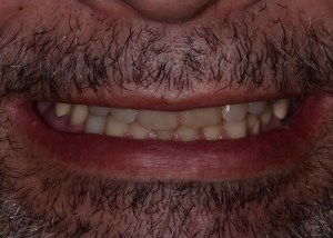 Complete Smile Makeover patient 5