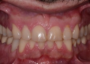Complete Smile Makeover patient 4