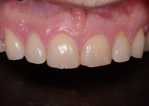 Complete Smile Makeover patient 5