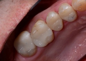 Crowns patient 4