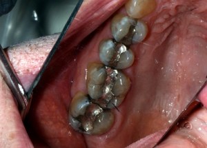 Crowns patient 4