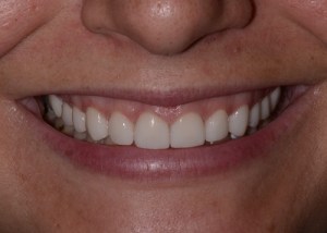 Complete Smile Makeover patient 1
