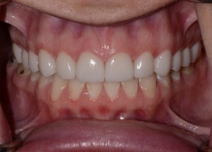 Complete Smile Makeover patient 1