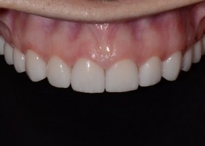 Complete Smile Makeover patient 1