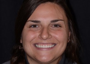 Complete Smile Makeover patient 1