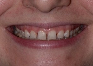 Complete Smile Makeover patient 1