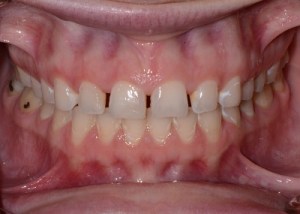 Complete Smile Makeover patient 1