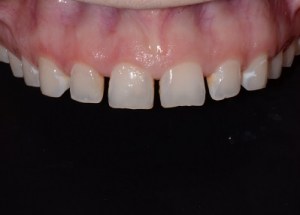 Complete Smile Makeover patient 1
