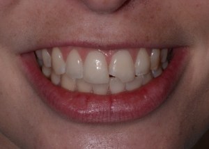Complete Smile Makeover patient 4