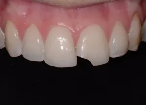 Complete Smile Makeover patient 4