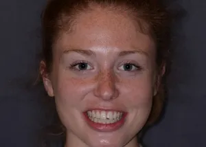 Complete Smile Makeover patient 4