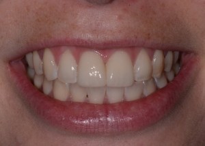 Complete Smile Makeover patient 4