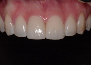 Complete Smile Makeover patient 4