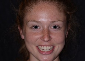 Complete Smile Makeover patient 4