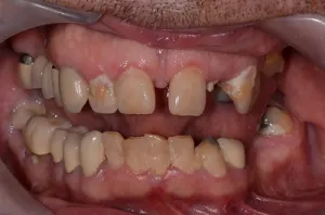 Complete Smile Makeover patient 8