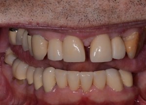 Complete Smile Makeover patient 8