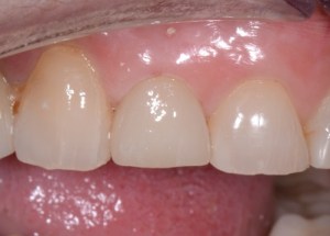 Crowns patient 3