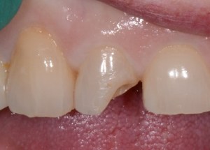 Crowns patient 3