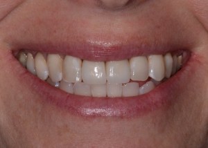 Crowns patient 2