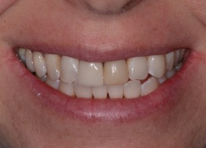 Crowns patient 2