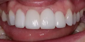 Complete Smile Makeover patient 13
