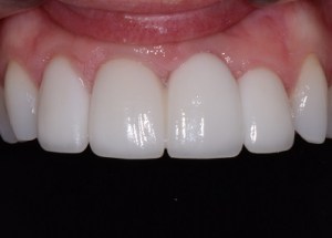 Complete Smile Makeover patient 13
