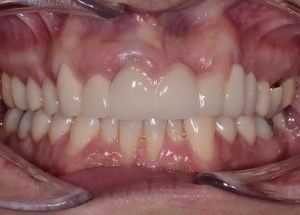Complete Smile Makeover patient 11