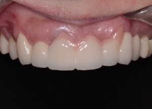 Complete Smile Makeover patient 11