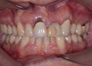 Complete Smile Makeover patient 11