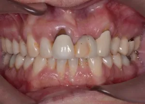 Complete Smile Makeover patient 11