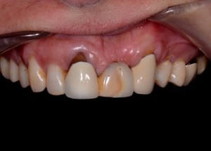 Complete Smile Makeover patient 11