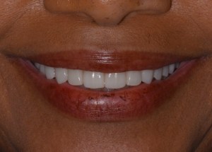 Complete Smile Makeover patient 6