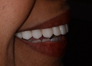 Complete Smile Makeover patient 6