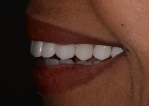 Complete Smile Makeover patient 6