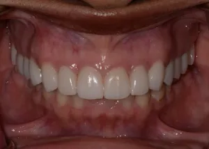 Complete Smile Makeover patient 6