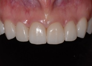 Complete Smile Makeover patient 6
