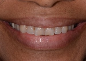 Complete Smile Makeover patient 6