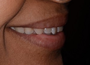 Complete Smile Makeover patient 6