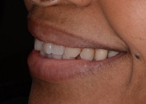 Complete Smile Makeover patient 6
