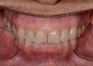 Complete Smile Makeover patient 6