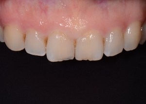 Complete Smile Makeover patient 6