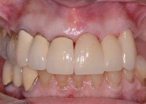 Complete Smile Makeover patient 12