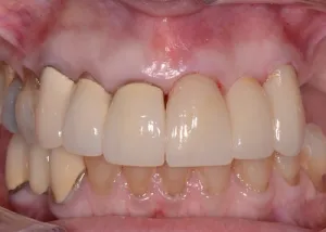 Complete Smile Makeover patient 10