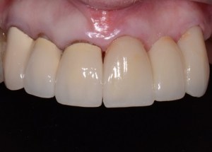 Complete Smile Makeover patient 10