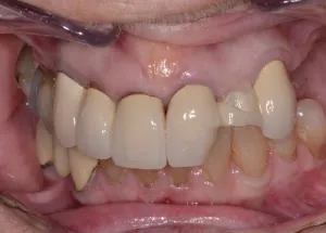 Complete Smile Makeover patient 12